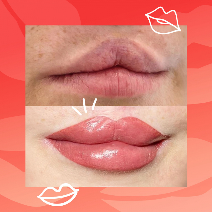 Cleft Lip Restoration Online Course with Gabrielle Rock