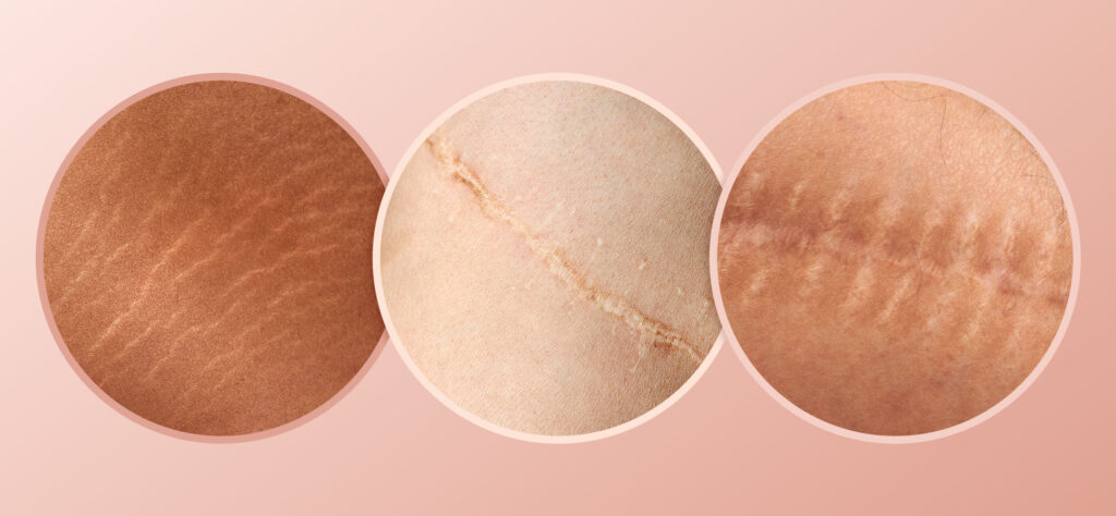 How Scar Camouflage and Medical Tattooing Restore Confidence After Scars